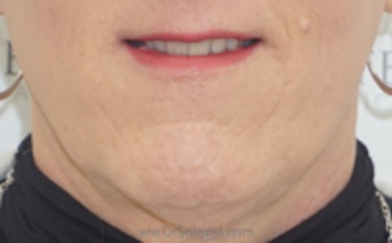 Mandible Contouring Before & After Gallery - Patient 607234 - Image 1