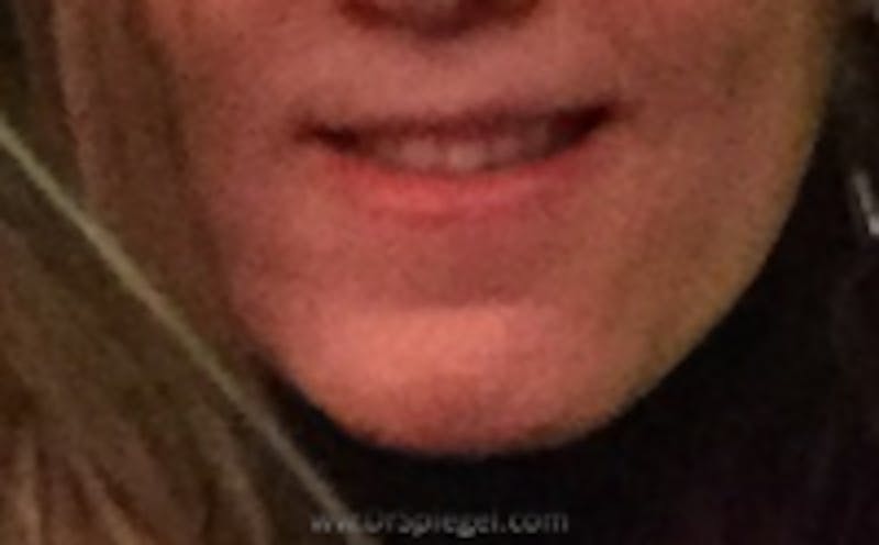 Mandible Contouring Before & After Gallery - Patient 607234 - Image 2