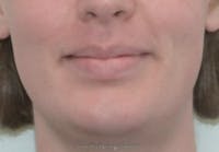 Mandible Contouring Before & After Gallery - Patient 343720 - Image 1
