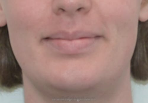 FFS Mandible Contouring Before & After Gallery - Patient 142194 - Image 1