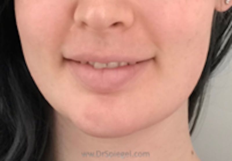 Mandible Contouring Before & After Gallery - Patient 343720 - Image 2