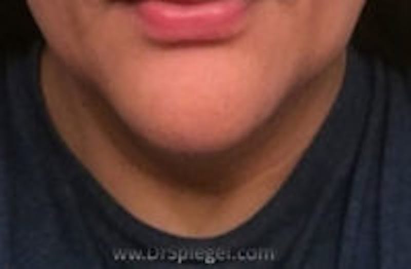 Mandible Contouring Before & After Gallery - Patient 291403 - Image 1