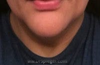 Mandible Contouring Before & After Gallery - Patient 291403 - Image 1