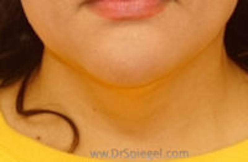 Mandible Contouring Before & After Gallery - Patient 291403 - Image 2
