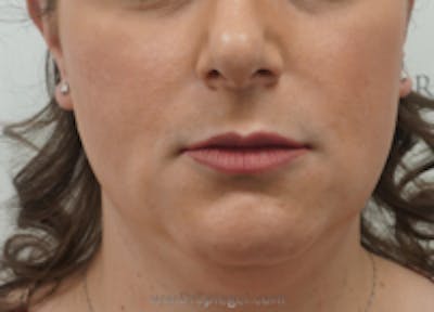 FFS Mandible Contouring Before & After Gallery - Patient 315226 - Image 1