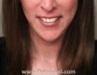 Mandible Contouring Before & After Gallery - Patient 862057 - Image 2