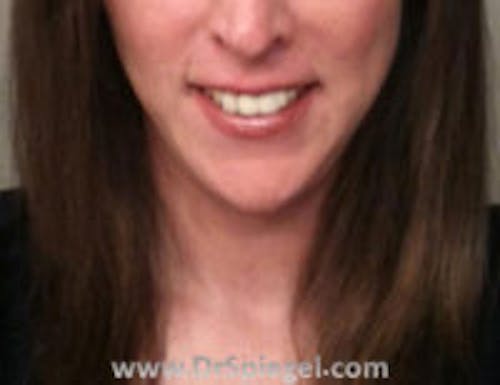 FFS Mandible Contouring Before & After Gallery - Patient 394715 - Image 2