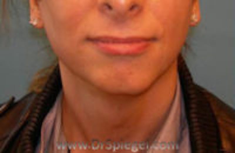Mandible Contouring Before & After Gallery - Patient 360034 - Image 1