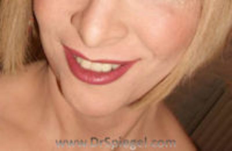 Mandible Contouring Before & After Gallery - Patient 360034 - Image 2