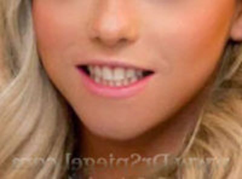 Mandible Contouring Before & After Gallery - Patient 417931 - Image 2