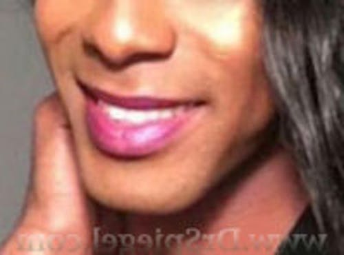 FFS Mandible Contouring Before & After Gallery - Patient 537000 - Image 1