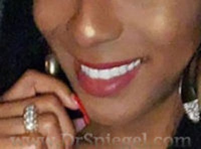 FFS Mandible Contouring Before & After Gallery - Patient 537000 - Image 2