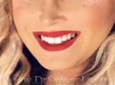 FFS Mandible Contouring Before & After Gallery - Patient 338789 - Image 2