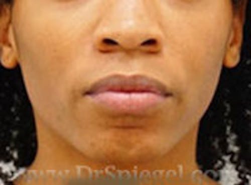 FFS Mandible Contouring Before & After Gallery - Patient 579591 - Image 1