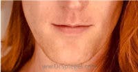 Mandible Contouring Before & After Gallery - Patient 268681 - Image 1