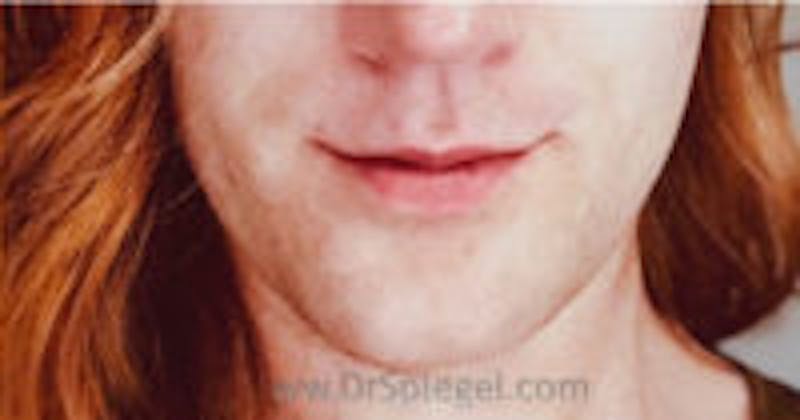 Mandible Contouring Before & After Gallery - Patient 268681 - Image 2