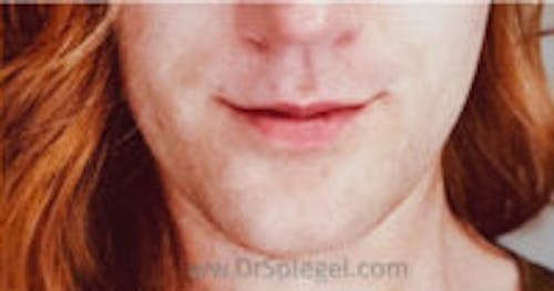 FFS Mandible Contouring Before & After Gallery - Patient 412443 - Image 2