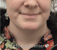 Mandible Contouring Before & After Gallery - Patient 494062 - Image 1