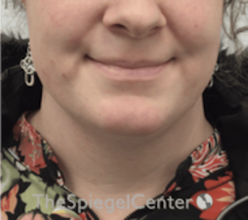 FFS Mandible Contouring Before & After Gallery - Patient 143436 - Image 1