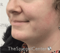 Mandible Contouring Before & After Gallery - Patient 494062 - Image 3