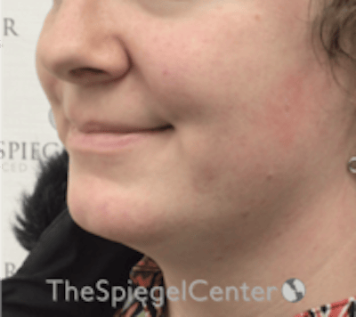 FFS Mandible Contouring Before & After Gallery - Patient 143436 - Image 3