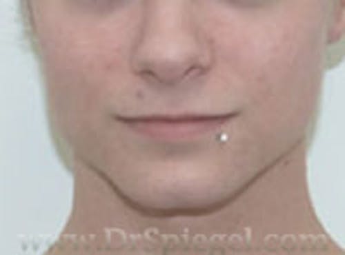 FFS Mandible Contouring Before & After Gallery - Patient 400310 - Image 1