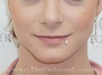 Mandible Contouring Before & After Gallery - Patient 569491 - Image 2