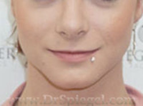 FFS Mandible Contouring Before & After Gallery - Patient 400310 - Image 2