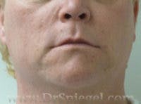 Mandible Contouring Before & After Gallery - Patient 131719 - Image 1