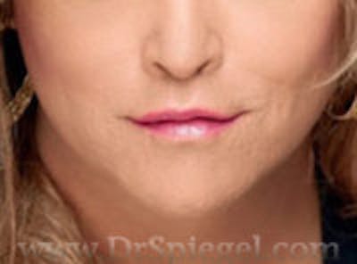 FFS Mandible Contouring Before & After Gallery - Patient 275569 - Image 2