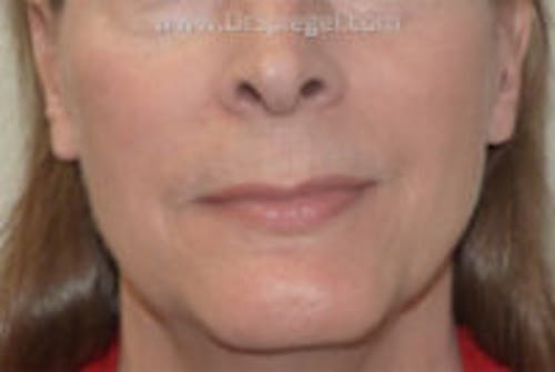 FFS Mandible Contouring Before & After Gallery - Patient 935301 - Image 1
