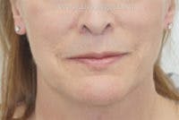 Mandible Contouring Before & After Gallery - Patient 311832 - Image 2