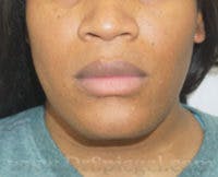 Mandible Contouring Before & After Gallery - Patient 579902 - Image 1