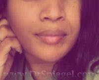 Mandible Contouring Before & After Gallery - Patient 579902 - Image 2