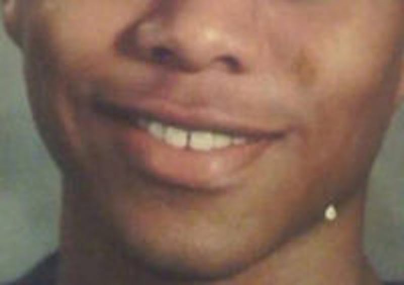 FFS Mandible Contouring Before & After Gallery - Patient 261386 - Image 1