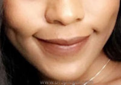 FFS Mandible Contouring Before & After Gallery - Patient 261386 - Image 2