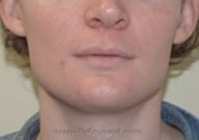 FFS Mandible Contouring Before & After Gallery - Patient 365528 - Image 1