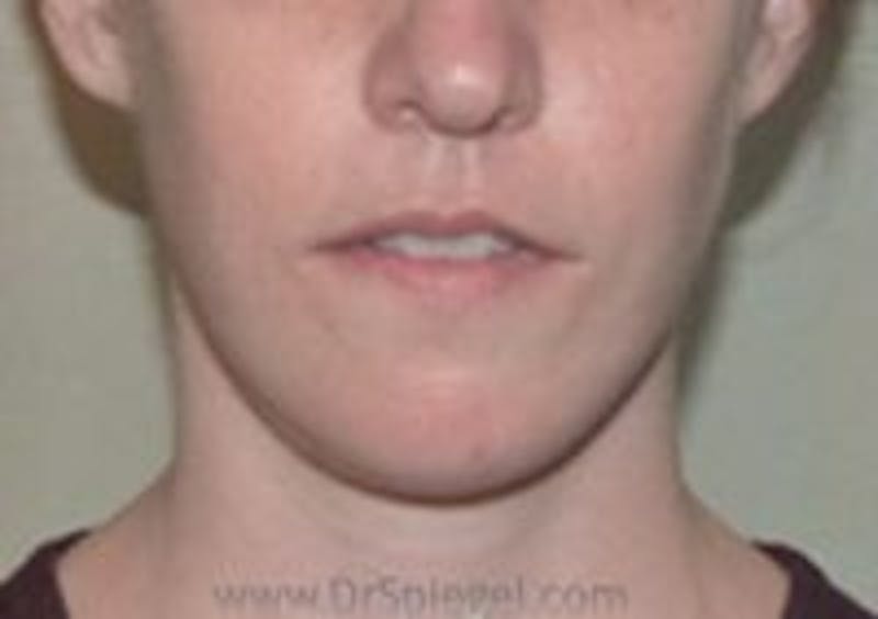 Mandible Contouring Before & After Gallery - Patient 224334 - Image 2