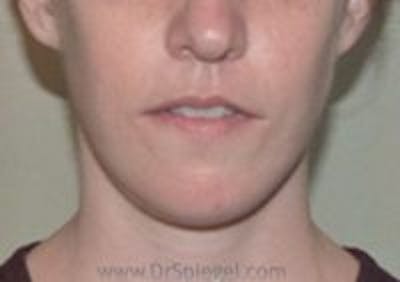 FFS Mandible Contouring Before & After Gallery - Patient 320268 - Image 2
