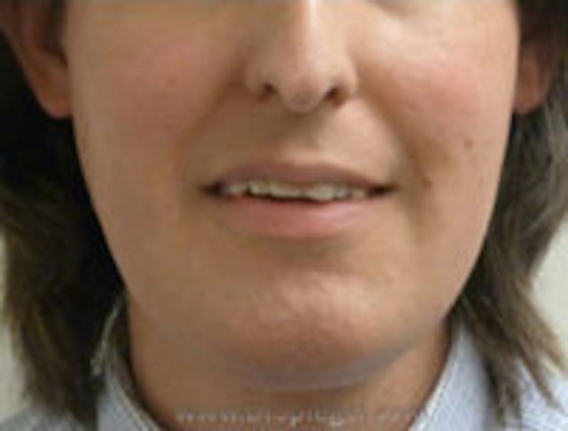 Mandible Contouring Before & After Gallery - Patient 353237 - Image 1