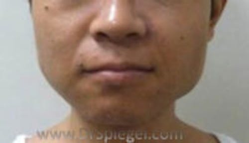 FFS Mandible Contouring Before & After Gallery - Patient 410377 - Image 1