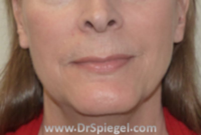 FFS Mandible Contouring Before & After Gallery - Patient 128058 - Image 1