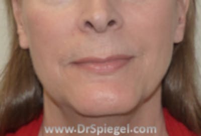 FFS Mandible Contouring Before & After Gallery - Patient 128058 - Image 1