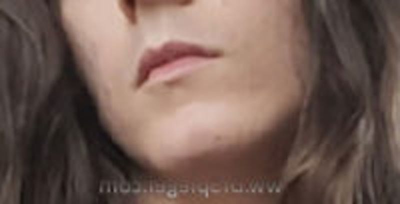 FFS Mandible Contouring Before & After Gallery - Patient 314160 - Image 1