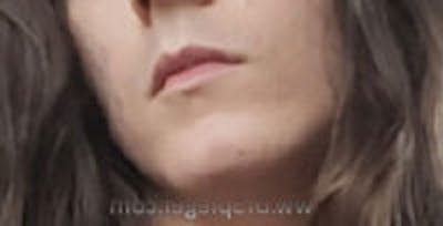 FFS Mandible Contouring Before & After Gallery - Patient 314160 - Image 1