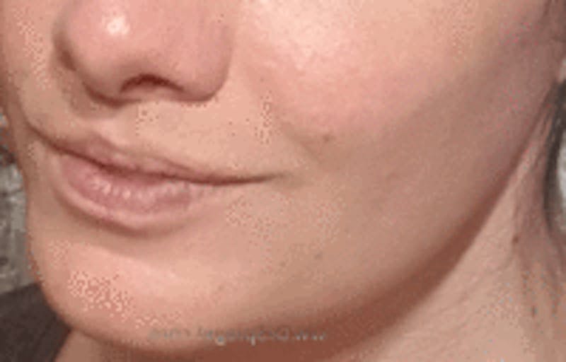 Mandible Contouring Before & After Gallery - Patient 209643 - Image 2