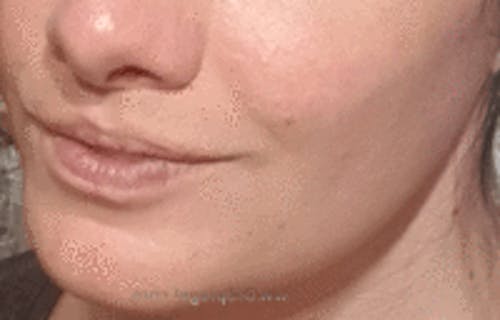 FFS Mandible Contouring Before & After Gallery - Patient 123829 - Image 2
