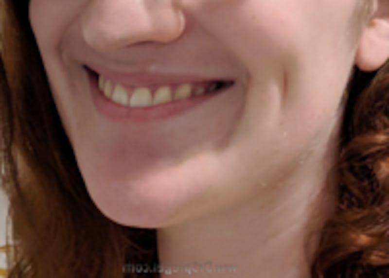 Mandible Contouring Before & After Gallery - Patient 150023 - Image 2