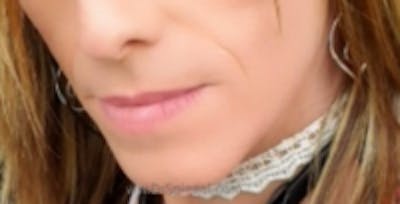 FFS Mandible Contouring Before & After Gallery - Patient 279701 - Image 1