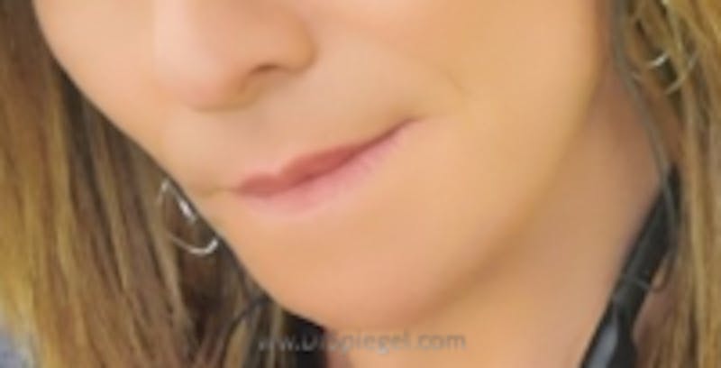 Mandible Contouring Before & After Gallery - Patient 328508 - Image 2